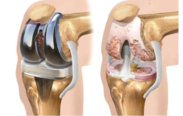 protesi ginocchio - ortopedico a Roma Dottor Gabriele Bolle