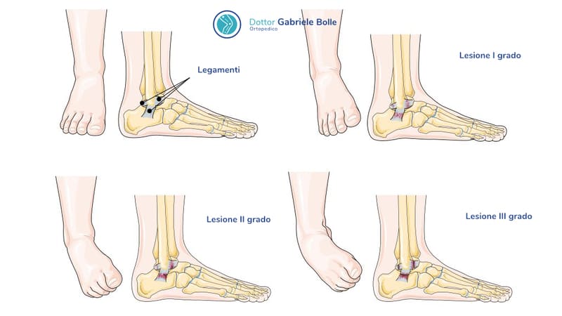 Distorsione della caviglia ortopedico a Roma Dottor Gabriele Bolle